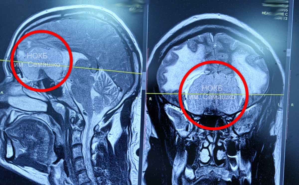 Мужчину с гигантской опухолью мозга спасли в Нижнем Новгороде - фото 1